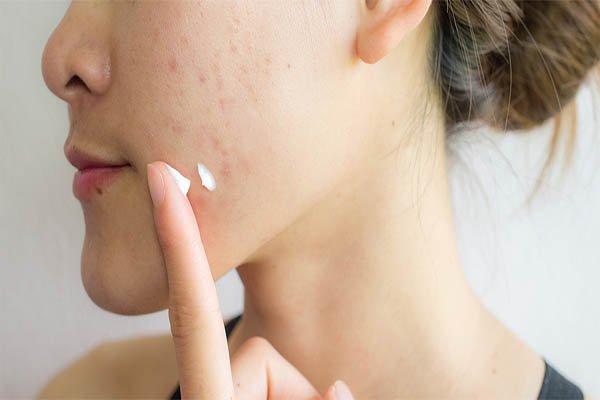 At-Home Treatments for Acne Scars