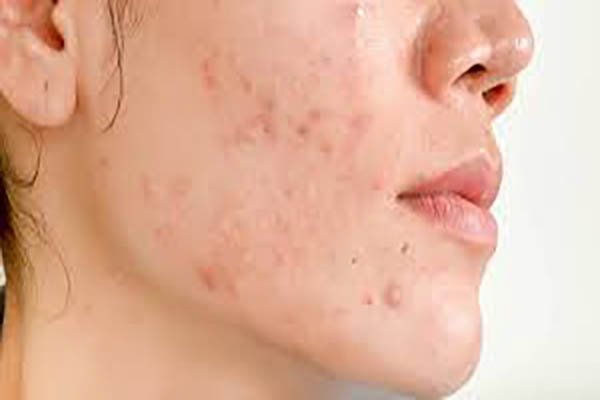 Treatments for Mild Acne Scars